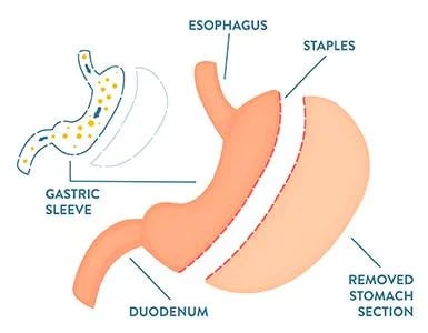 Gastric sleeve graphic of stomach split in two